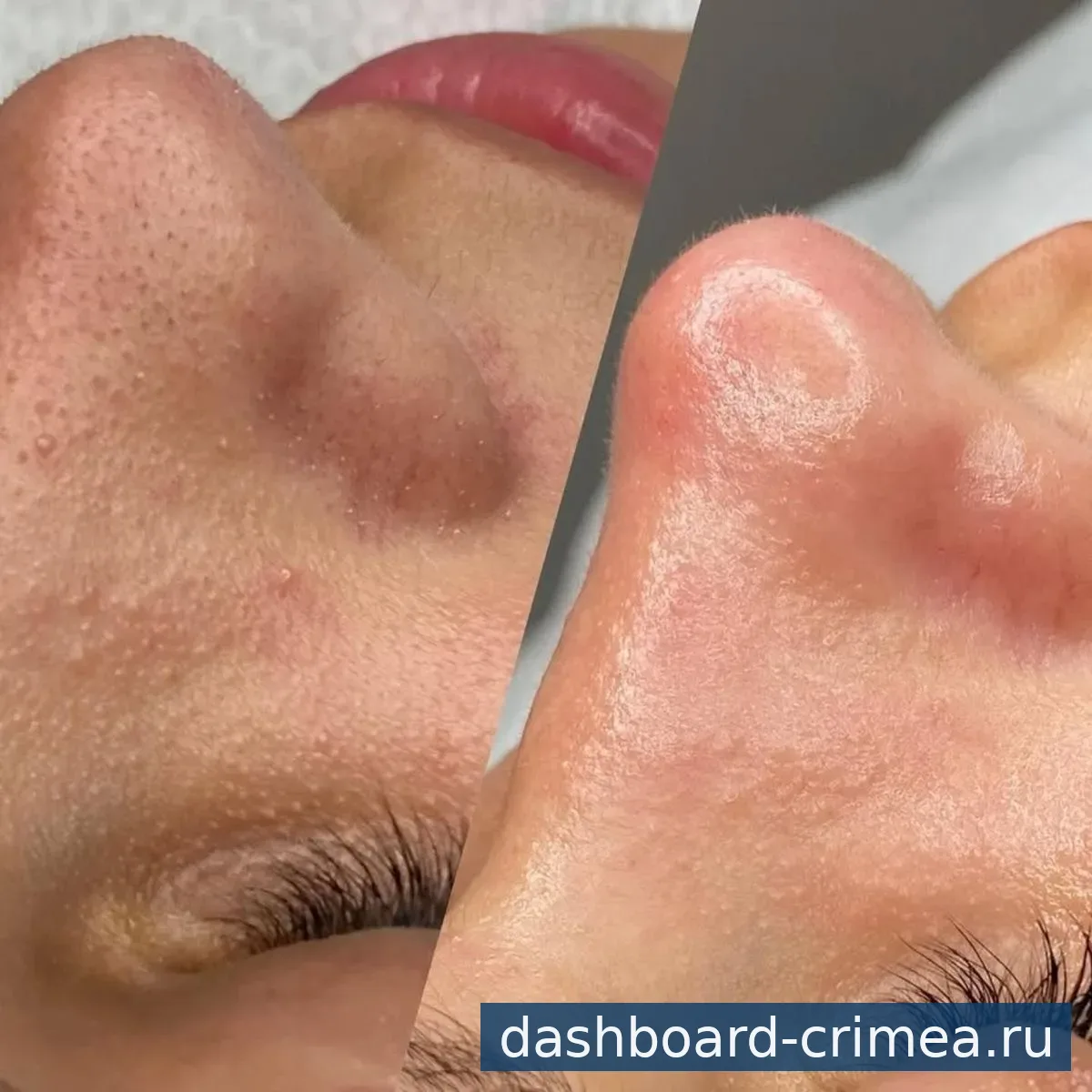 Чистка лица — Красота и здоровье — Красногвардейское — фото 3