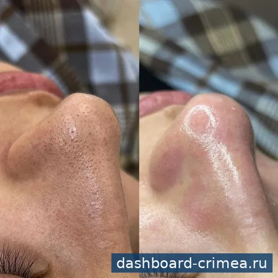 Чистка лица — Красота и здоровье — Красногвардейское