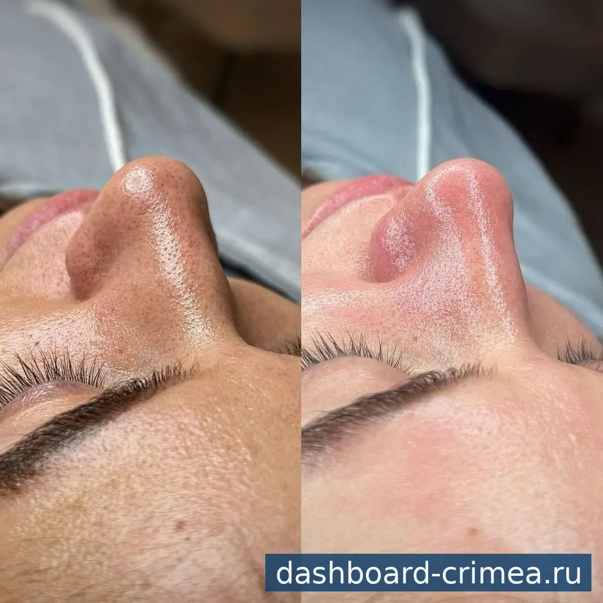 Чистка лица — Красота и здоровье — Красногвардейское — фото 2